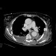Aneurysm of the thoracic aorta, circular thrombosis: CT - Computed tomography
